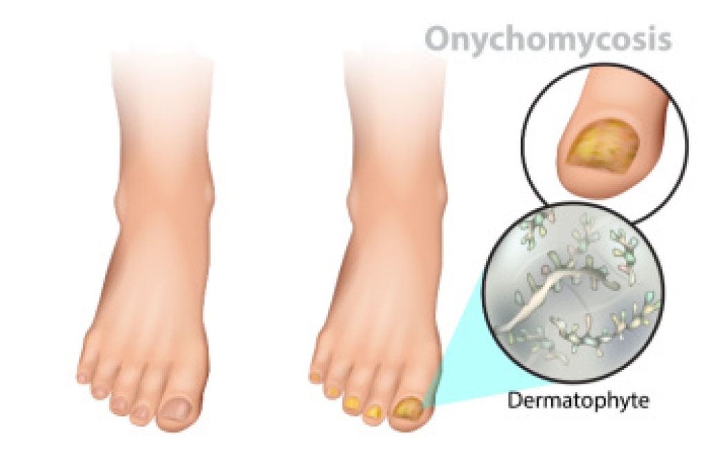 Stages of Toenail Fungus and When to Seek Care