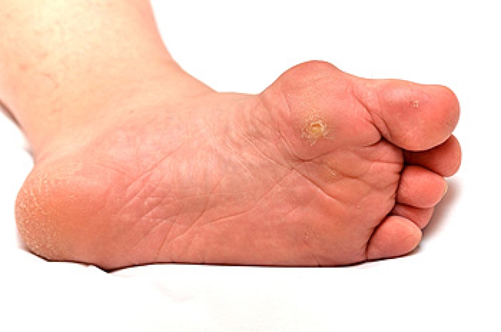 Causes of Corns and Calluses