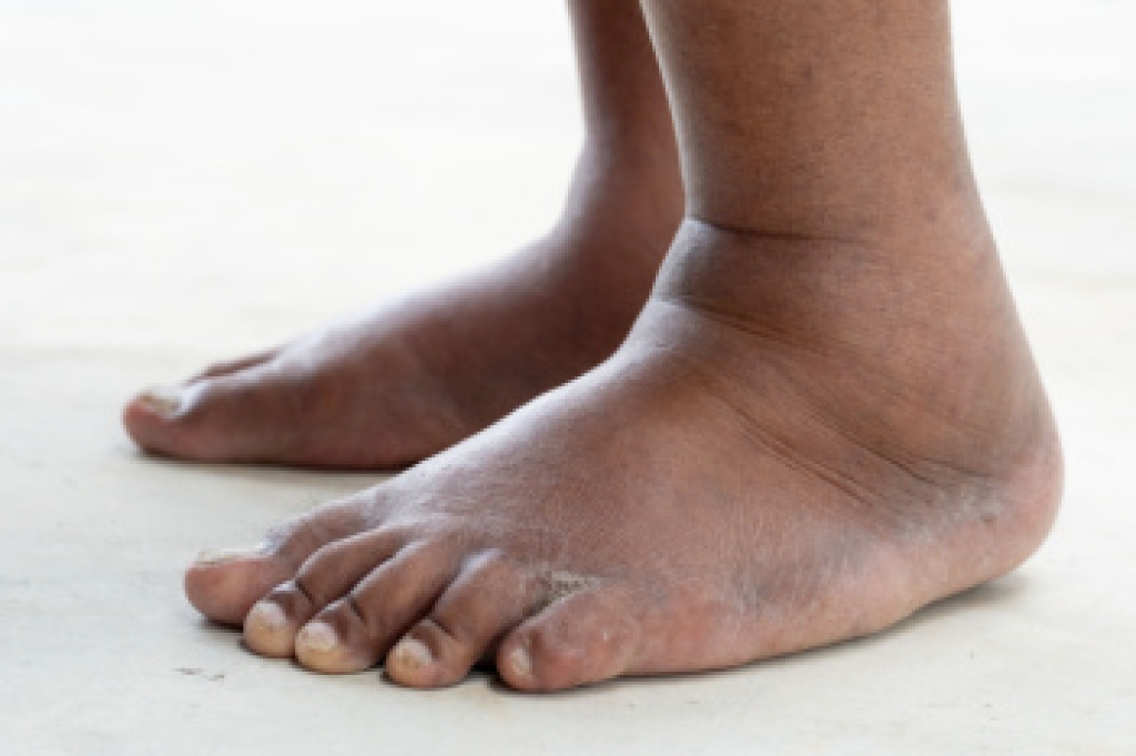 Dealing With Swollen Feet