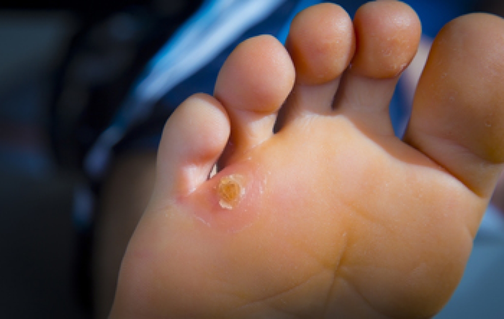 Managing Painful Corns and Calluses on the Feet