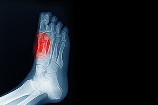 Big Toe Pain Caused by Sesamoiditis