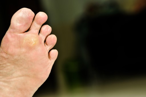 All About Plantar Warts