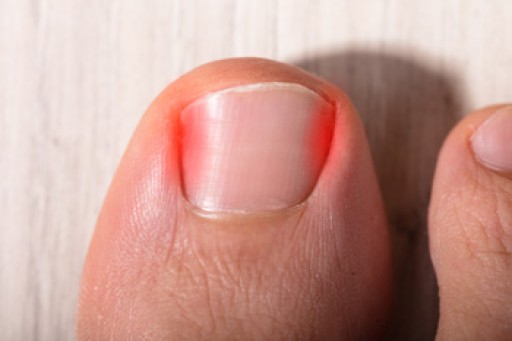 Ingrown Toenails Are a Serious Foot Condition