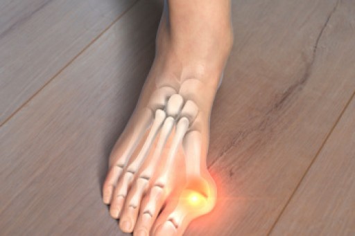Bunions and Relief Methods