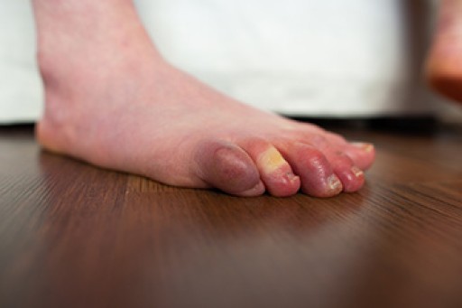 Raynaud's Phenomenon and Its Impact on the Feet