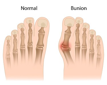 Understanding Bunions
